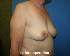 plastic-surgery-breast-augmentation